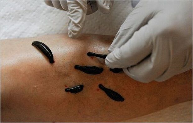 treatment of osteoarthritis of the knee by leeches