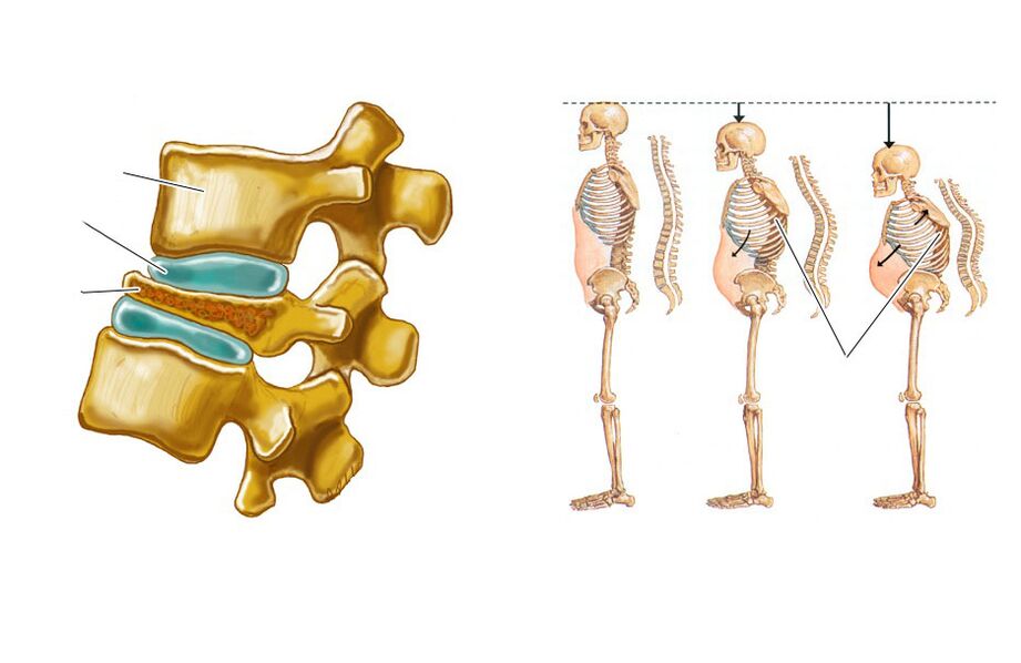 a relaxed spine leads to back pain