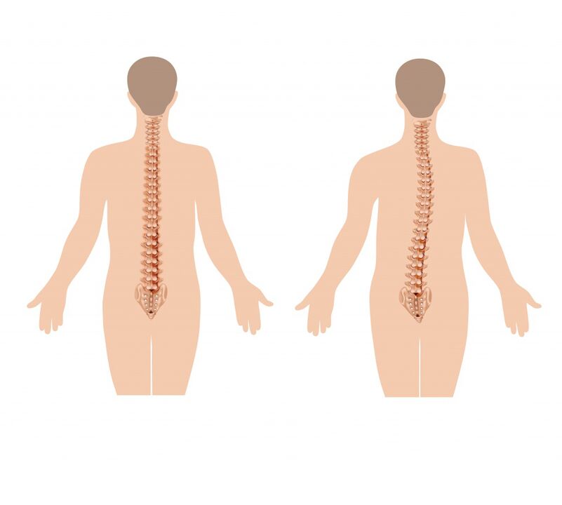 healthy and diseased spine