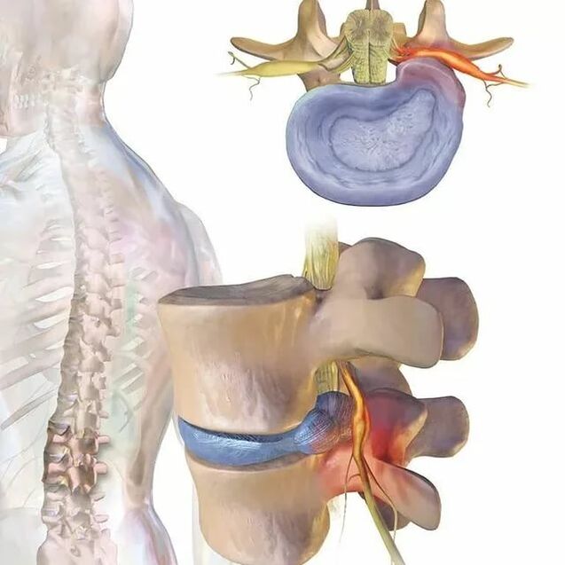 problems with intervertebral discs