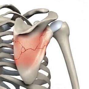 A scapular fracture is one of the causes of severe pain