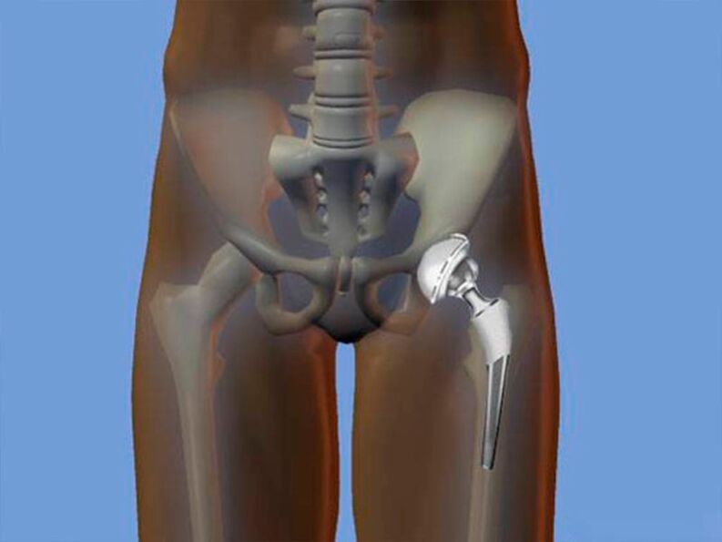 hip arthroplasty for pain