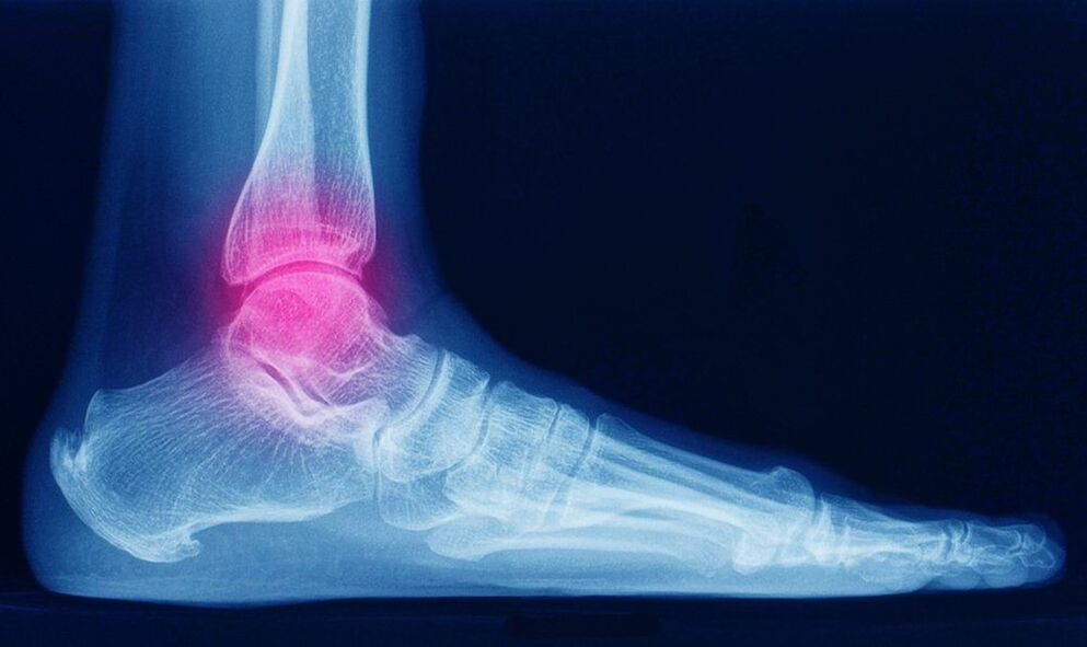 symptoms of arthrosis of the ankle joint