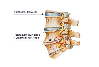 Symptoms of cervical degenerative disc disease