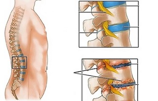 causes of osteochondrosis of the lumbar spine