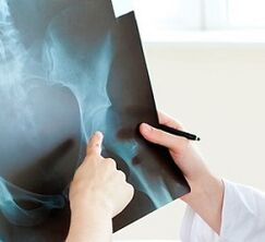 how to treat hip osteoarthritis