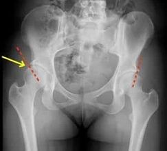 methods of treating hip arthrosis