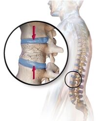 Osteoporosis causes back pain in the lumbar region