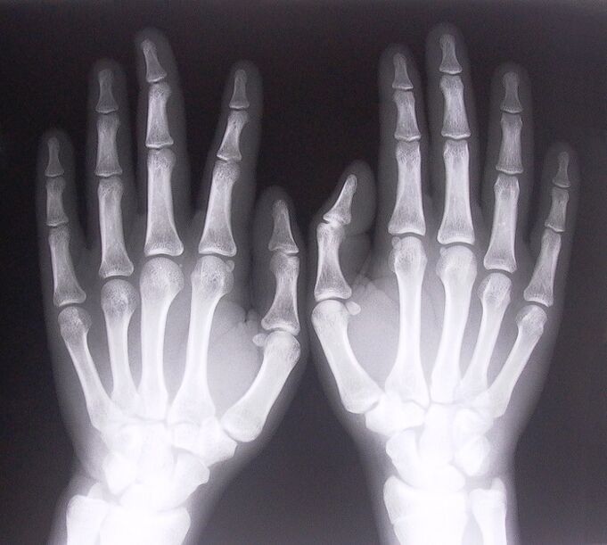 X-ray as a way to diagnose pain in the finger joints